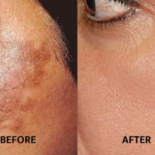 वाग डाग / Melasma           1) वाग क्रीम Night                   2) वाग Saban          3) वाग डाग Fes Pack